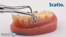 Walser® Matrici Sezionali: L'applicazione forma X da matrix dentale