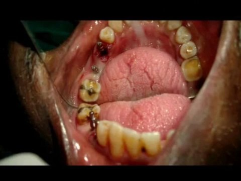 Painless extraction of periapical abscess tooth and implant supported bridge in india-chennai