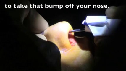The MicroRhino - Remove your Nasal bump without Breaking your Nose - Dr. Philip Miller