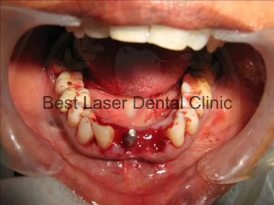 Immediate new teeth replacement by BCS (Basal Cortical Screw) Implants