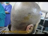 FUE in pakistan,FUE hair transplant surgery,Gujrat Pakistan,Lahore,www.fuepakistan.com