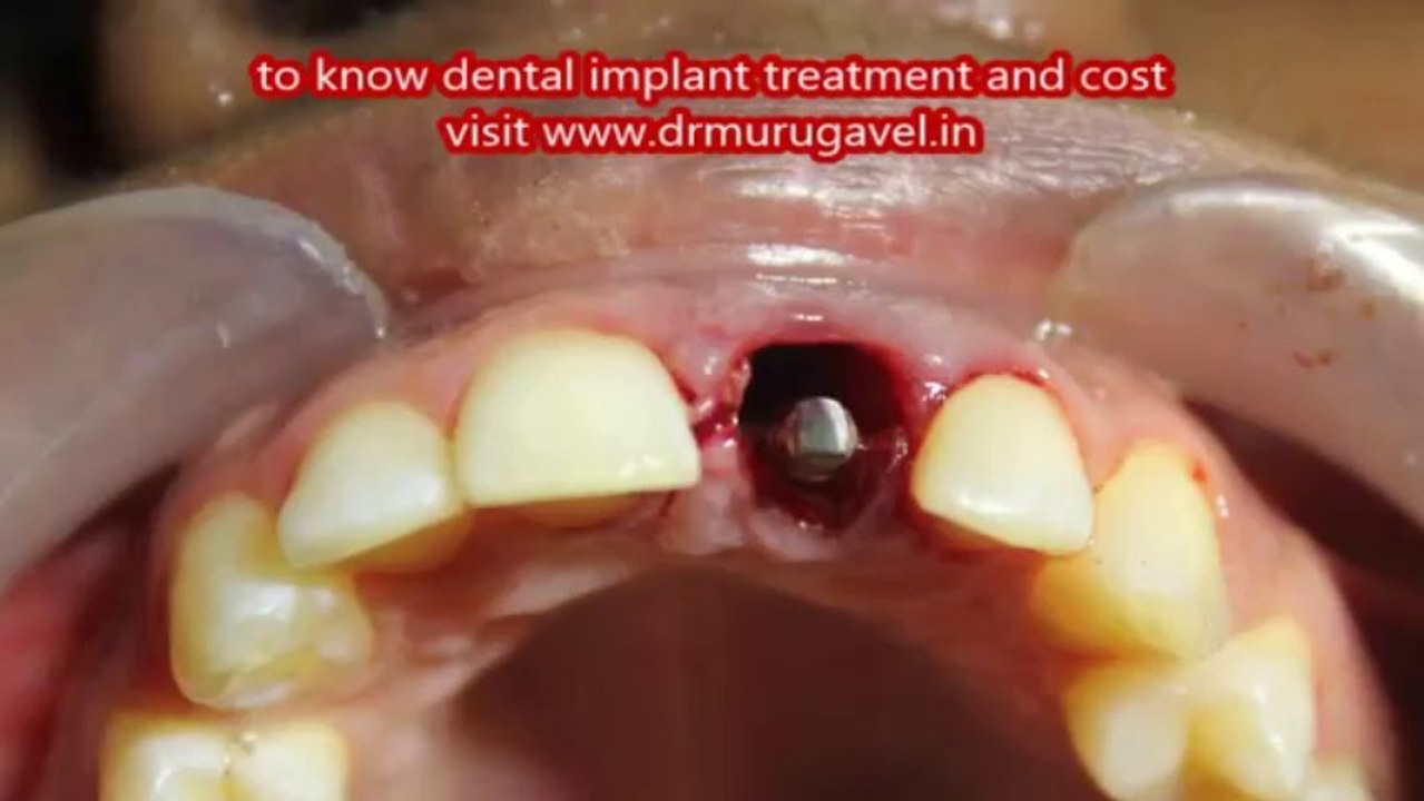 Fractured front teeth treatment in chennai-By Dental implants!