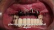 fixed teeth with basal implant without any bonegraft