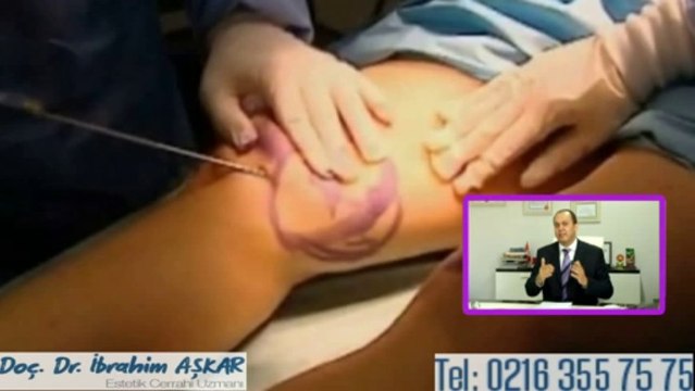 Lazer liposuction ile normal liposuction arasındaki farklar nelerdir