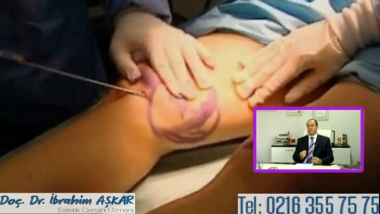 Doç.Dr. İbrahim Aşkar Liposuction-2 Bolum