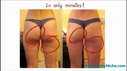 Cellulite Factor - Men vs. Women - What Causes Cellulite