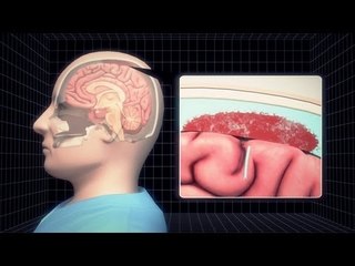 Argentina's President Cristina Kirchner's brain condition explained