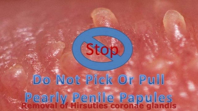 Pink pearly papules