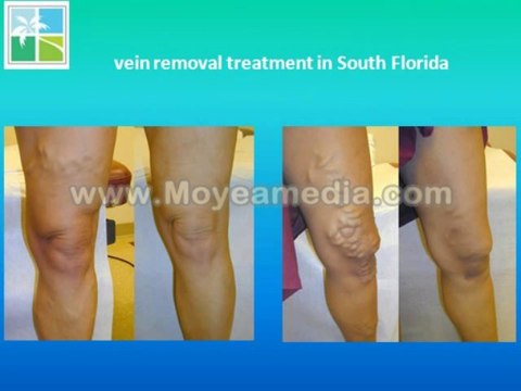 vein removal treatment in South Florida