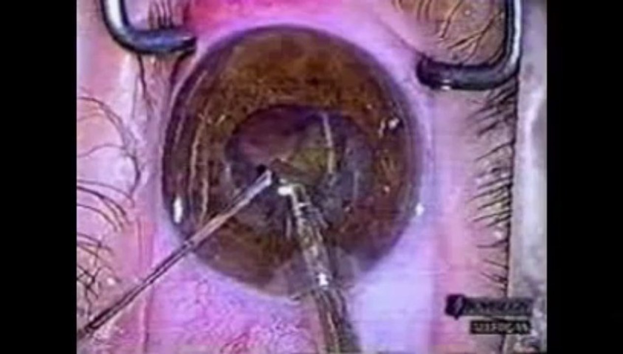Capsulorrhexis