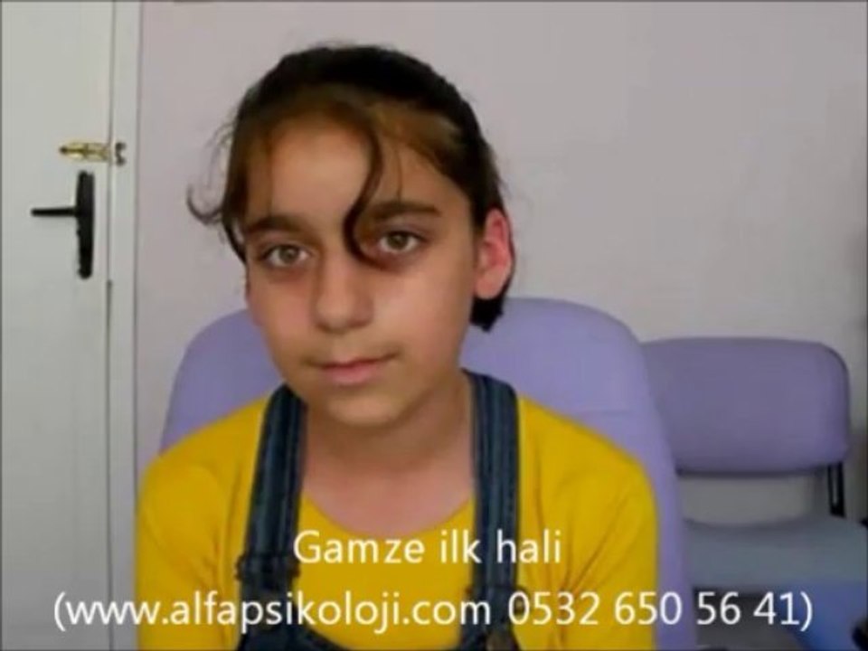kekemelik