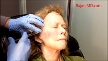 Voluma-Dr Rajani Injects 3D-Before and After