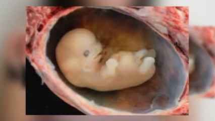 Lower back pain in pregnancy