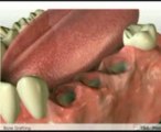Bone Grafting Implants - Jaw and Jawbone Grafting Facial Reconstruction-1