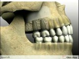 Bone Grafting Implants - Jaw and Jawbone Grafting Facial Reconstruction-2