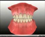 Dental Implants Virginia Beach - Dental Implant Procedure-2