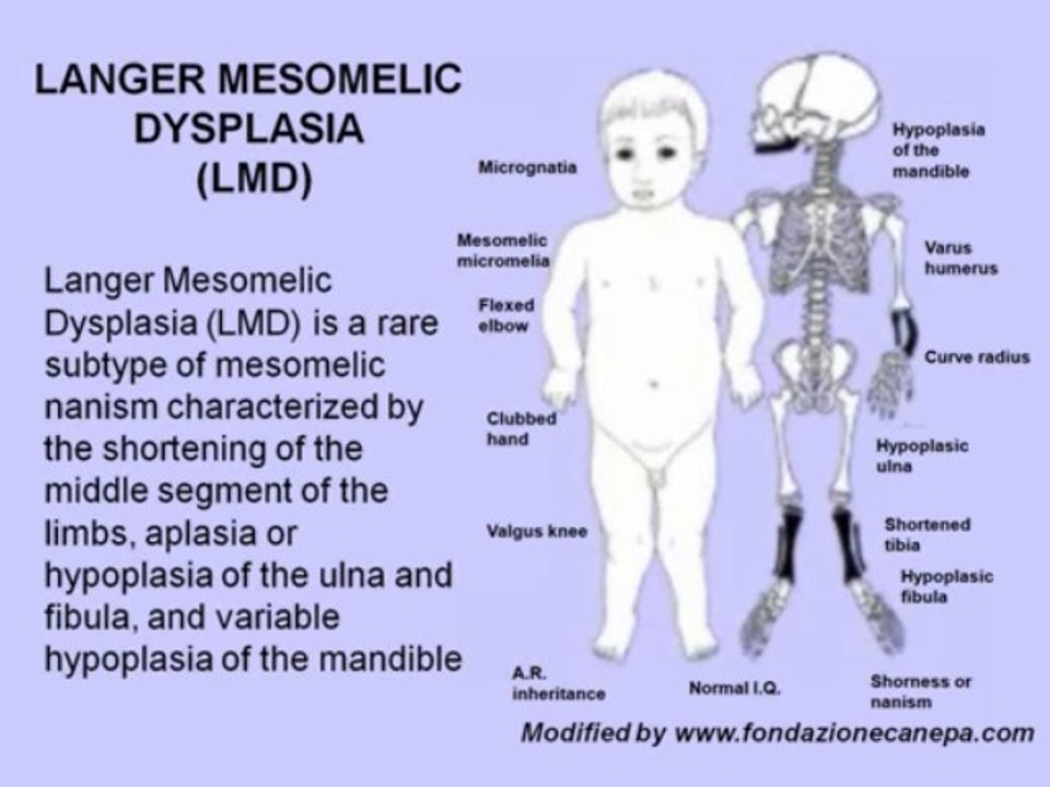 Langer mesomelic dysplasia