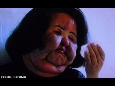 Plastic surgery gone wrong: Korean model disfigured after cooking oil injections