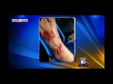 Shark attack in Florida: shark mauls teen's leg