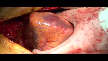 Meet the first HEARTLESS man who is able to live without a heartbeat or a PULSE  Mail Online