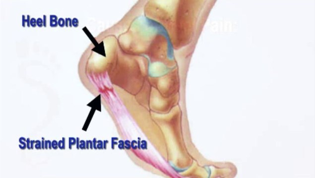 Podiatrist - Heel Pain - DeBary, DeLand and Deltona, Fl