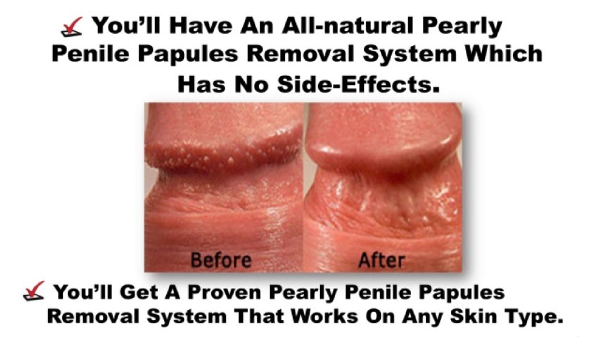 Papules is it what penile 3 Ways