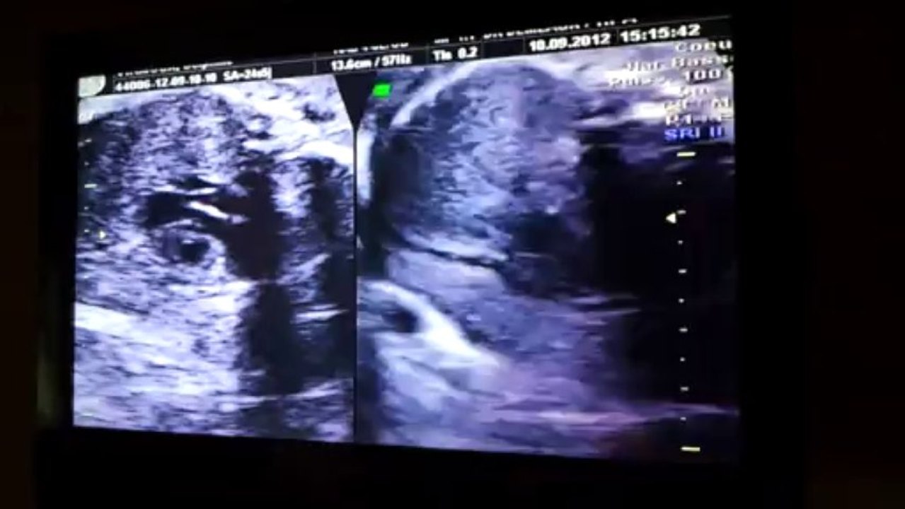 Deuxième échographie Giulia