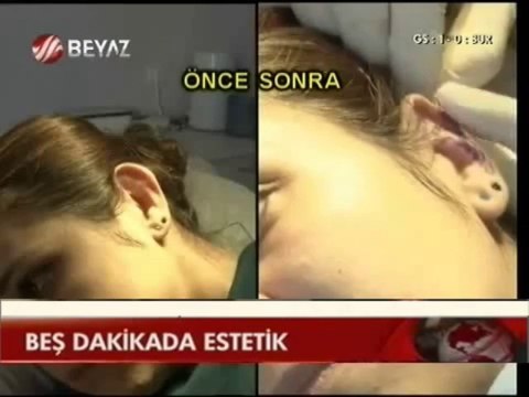 Op Dr Mustafa Ali YANIK Ameliyatsız Burun Estetiğini anlatıyor