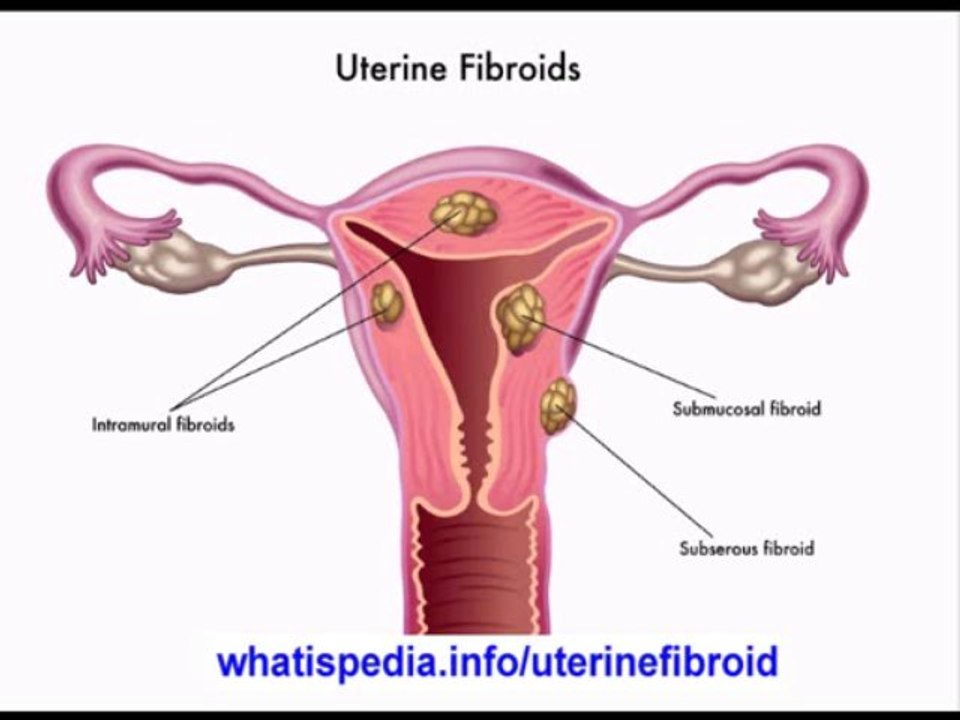WHAT IS UTERINE FIBROID? whatispedia.info/uterinefibroid