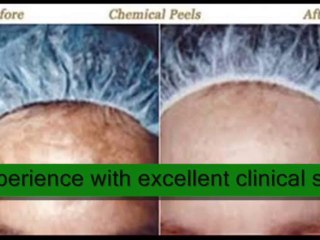 Chemical Skin Peel Brighton