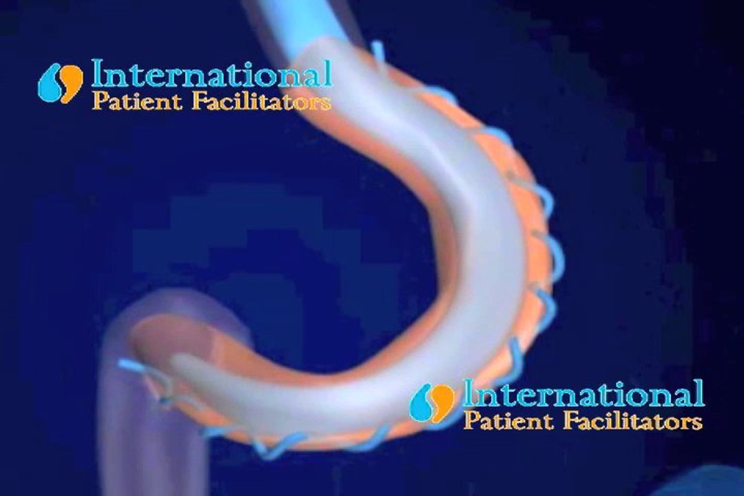 Gastric Plication Cancun & Tijuana, Mexico, by Sheri Burke