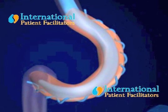 Gastric Plication Cancun & Tijuana, Mexico, by Sheri Burke