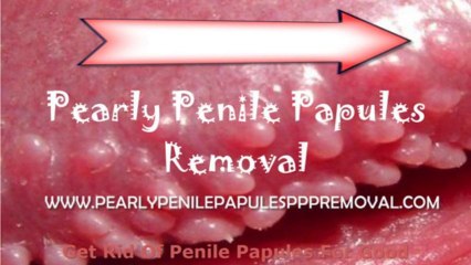 Wiki pearly penile papules