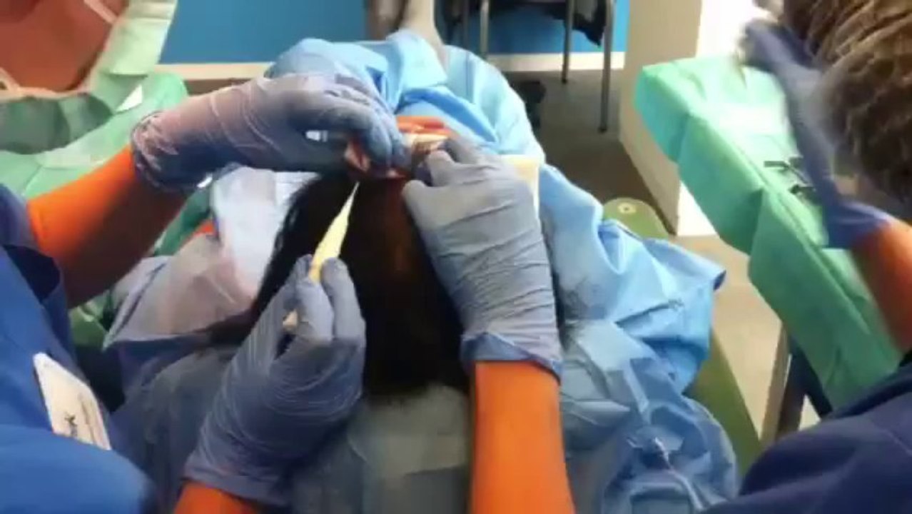 Trasplante de pelo. Implante Capilar en Bilbao. Tecnica FUE