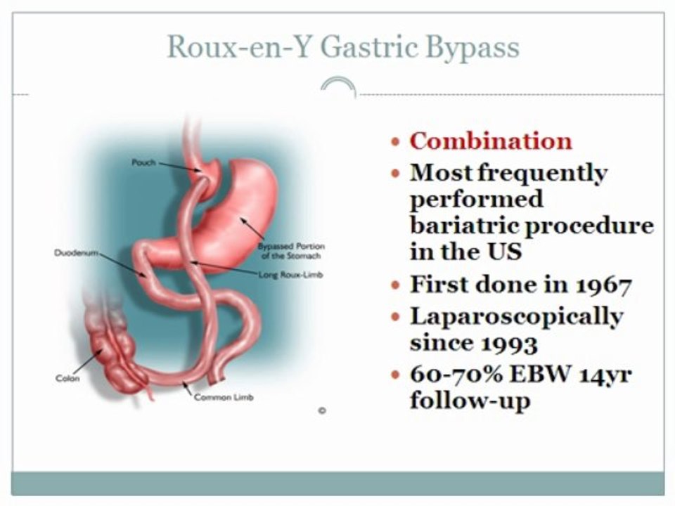 bariatric Surgery