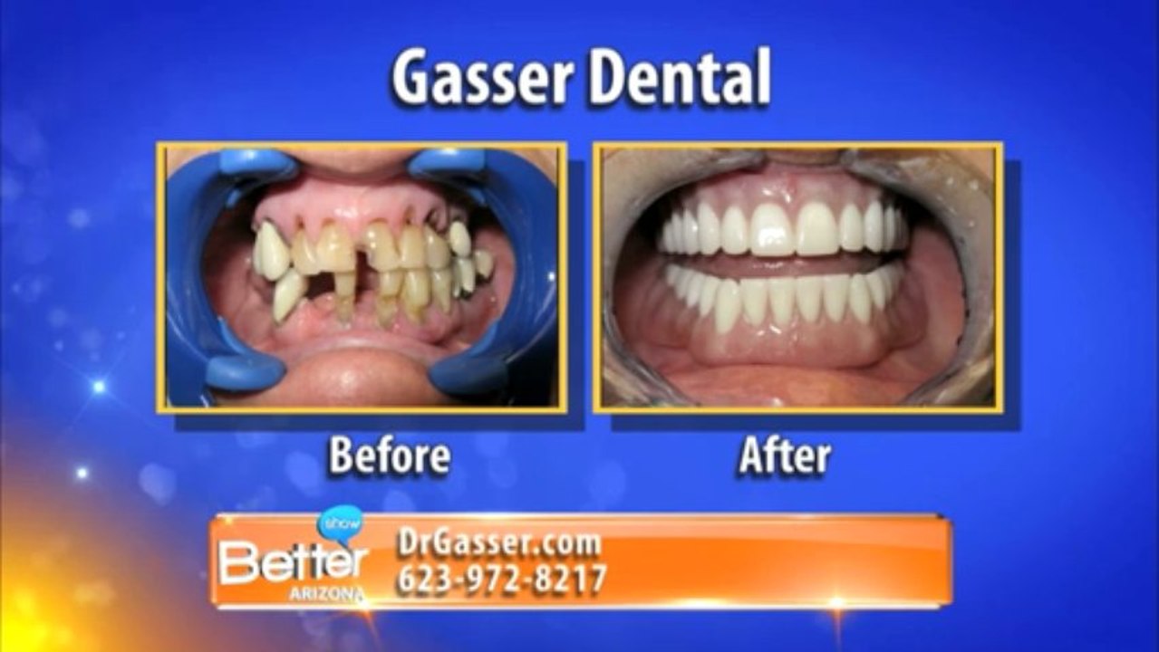 Dr Gasser Discusses Dental Implants on Better Arizona