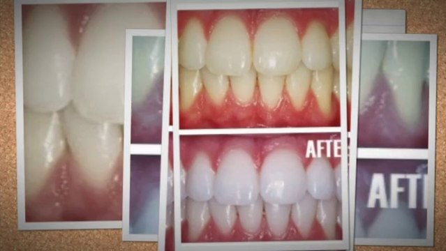 Hydrogen peroxide teeth whitening