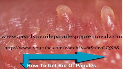 Coronae Glandis Using Removal Methods For Coronae Glandis