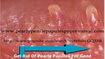 Papules Using Removal Techniques For Papules