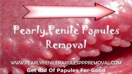 Pearly White Papules Using Removal Methods For Pearly White Papules