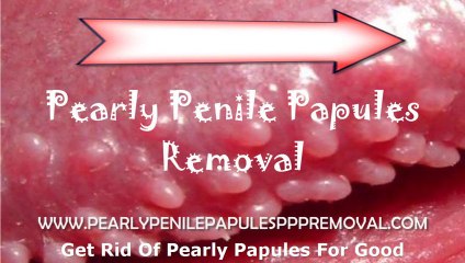 PPP Treatment Using Removal Techniques For PPP Treatment