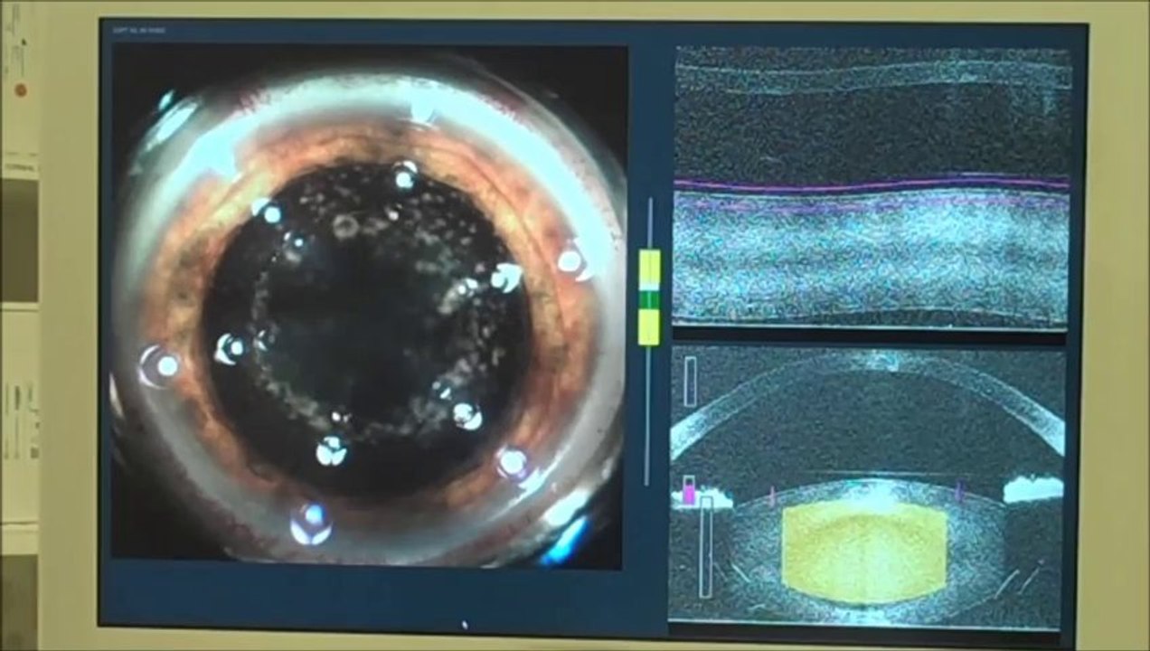 Clearwater Bladeless Cataract Eye Surgery Clearwater FL