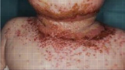 Understanding Hand Eczema & Its Treatments 🖐️