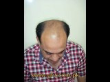 hair transplant,Lahore Pakistan,www.fuepakistan.com