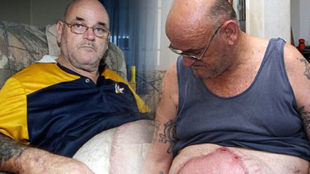 Man Drinks Beer He Dropped In River, Catches Stomach Bug That Keeps Growing (graphic)