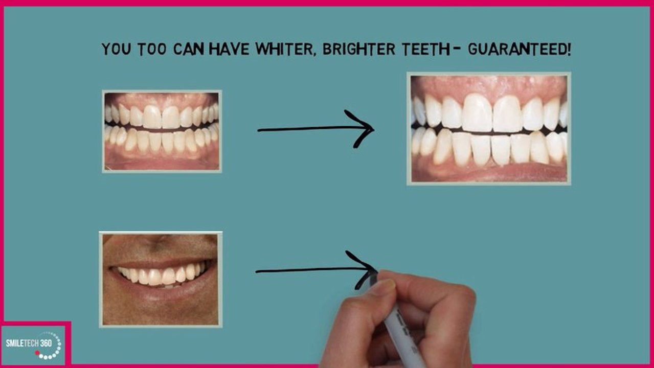 Effective LED Teeth Whitening| Smile Tec360