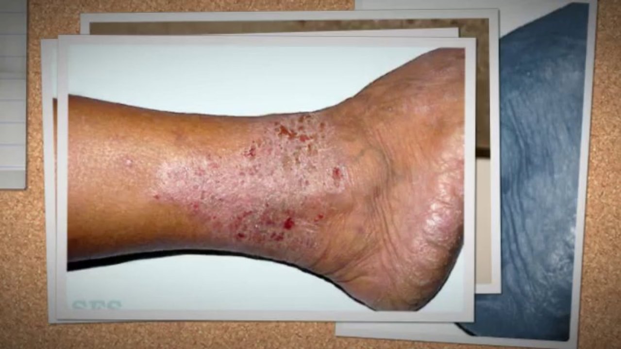 Types of eczema