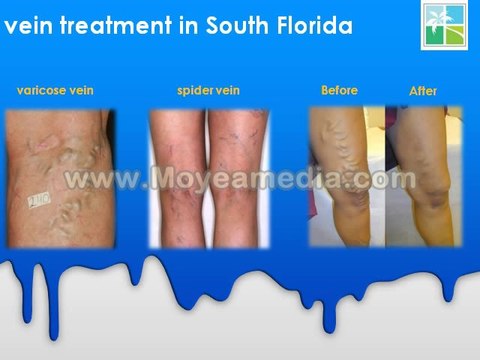 Vein treatment in South Florida