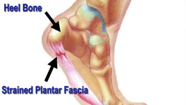 Heel Pain - Minneapolis,St. Paul, Twin Cities, MN - Podiatrist Dale Vancil