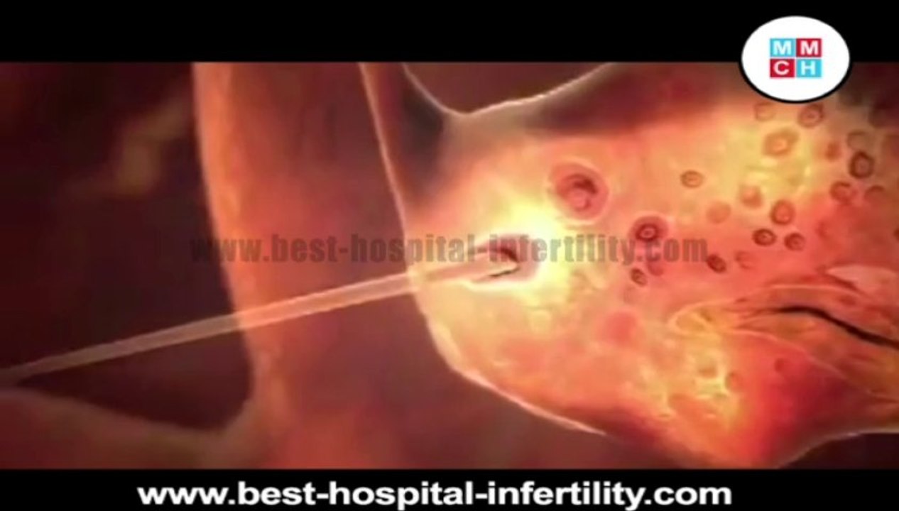 IVF ProcedureTamil Nadu